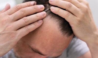 5 Effective Ways to Reclaim Your Hairline